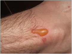 Blister on Daniel's foot